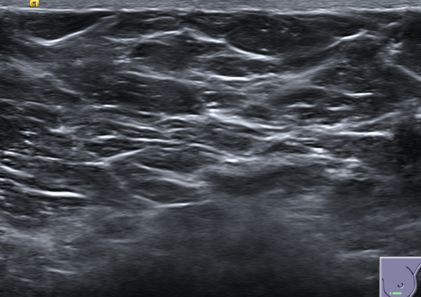 Breast ultrasound of normal tissue