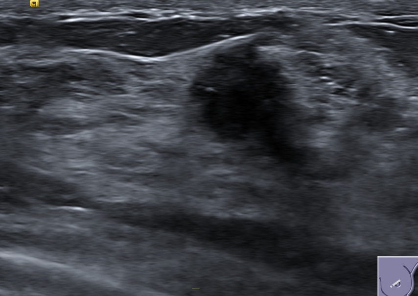 Breast ultrasound of a malignant lesion with a distinct focal region