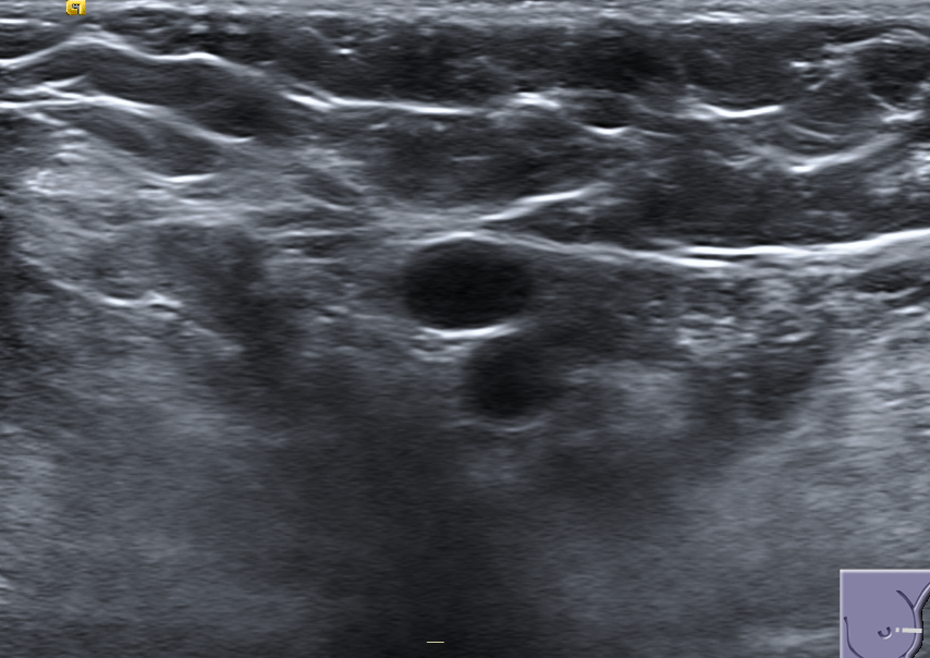 Breast ultrasound of benign lesions